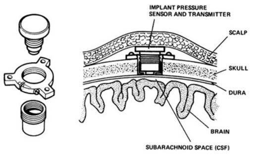 Body Image 2-Recent Advances in Implantable-BioMEMS-Electronics